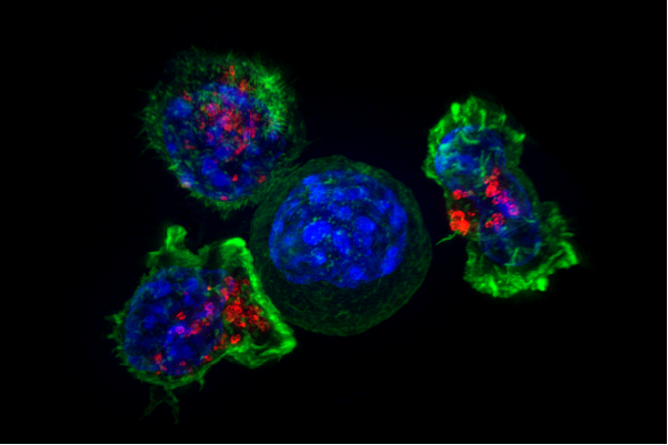 T-cells attack a cancer cell, playing a big role in immunotherapy